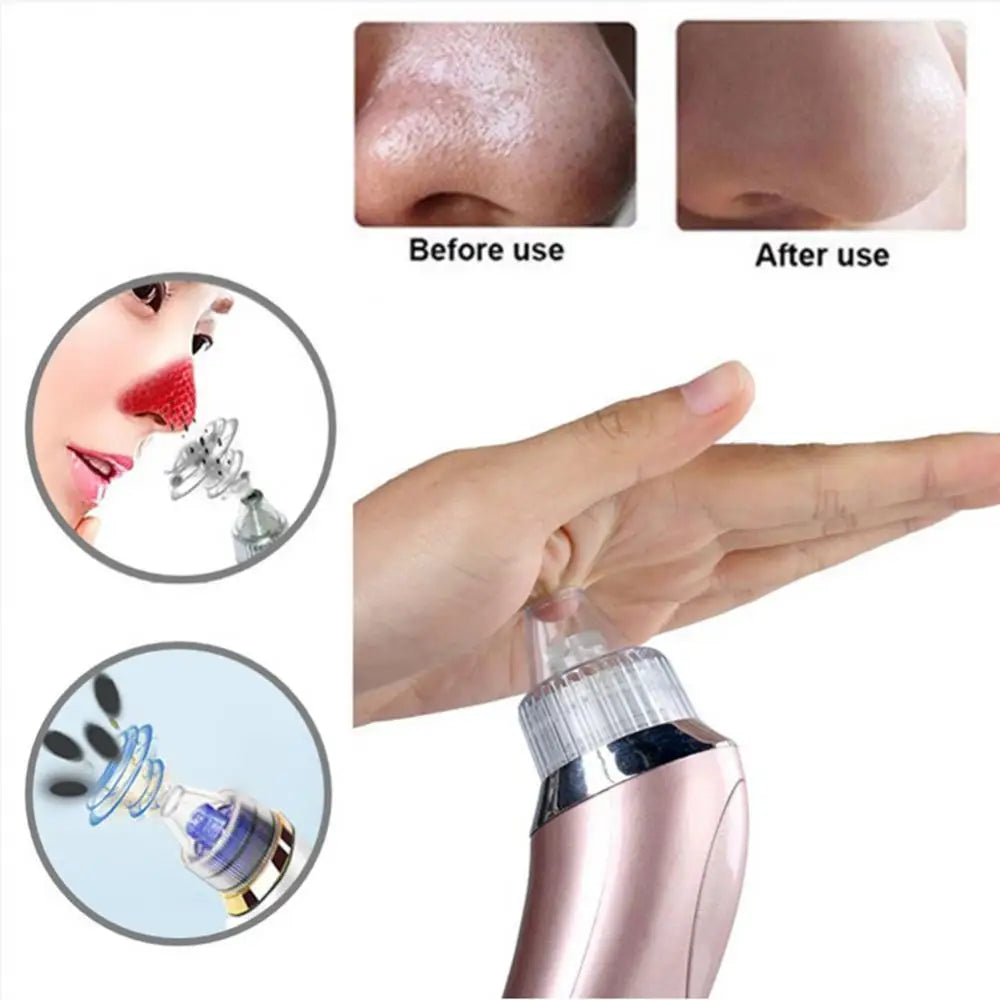 Acne Vacuum I  Skincare Exfoliating