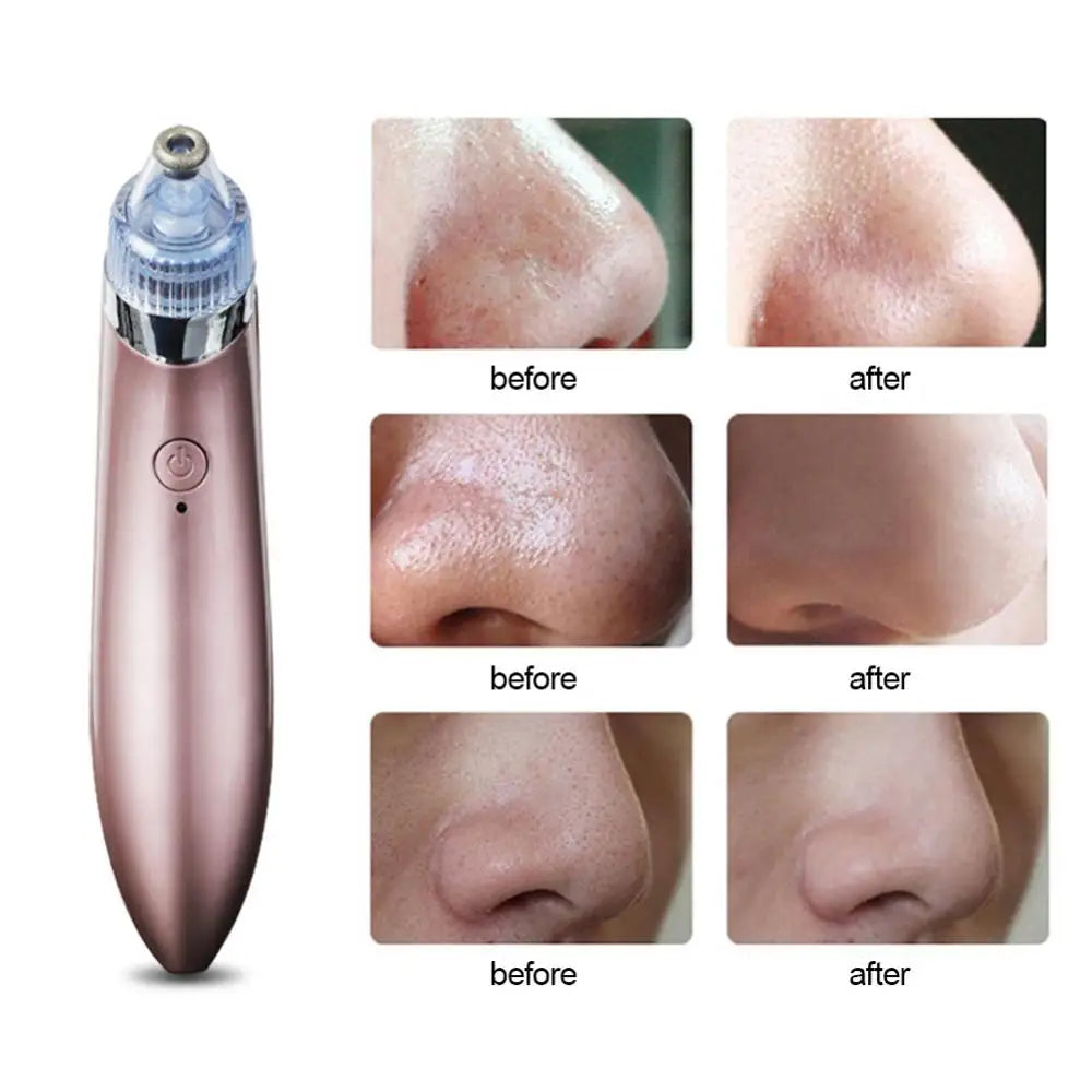 Acne Vacuum I  Skincare Exfoliating